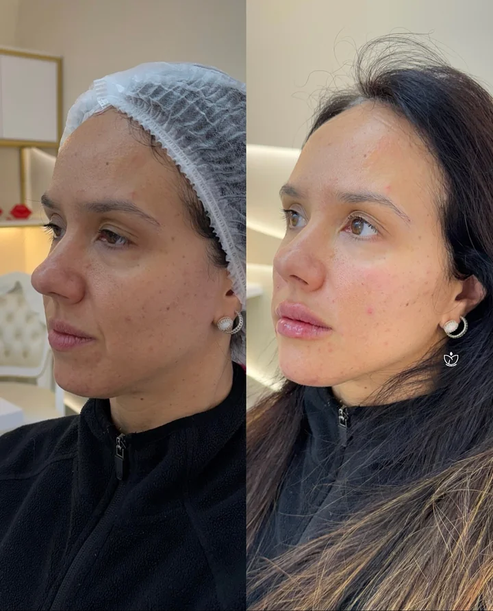 Antes e depois de harmonização facial, três quartos