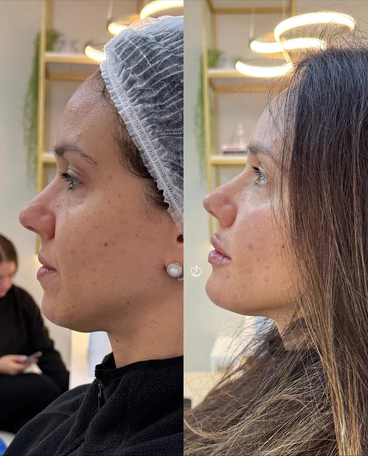 Antes e depois de harmonização facial, perfil
