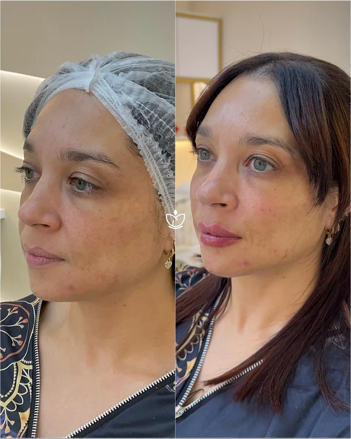 Antes e depois de harmonização facial, contorno e pele