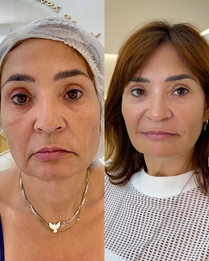 Antes e depois de harmonização facial full face em paciente madura