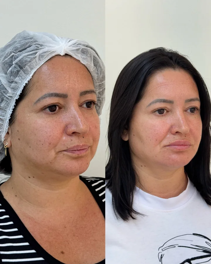 Antes e depois de harmonização facial full face