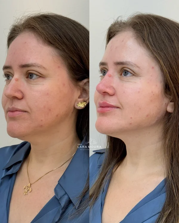 Antes e depois de harmonização facial, contorno