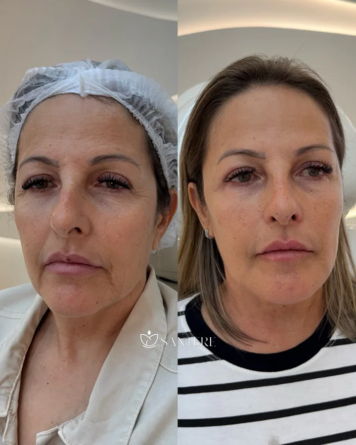 Antes e depois de harmonização facial, frente