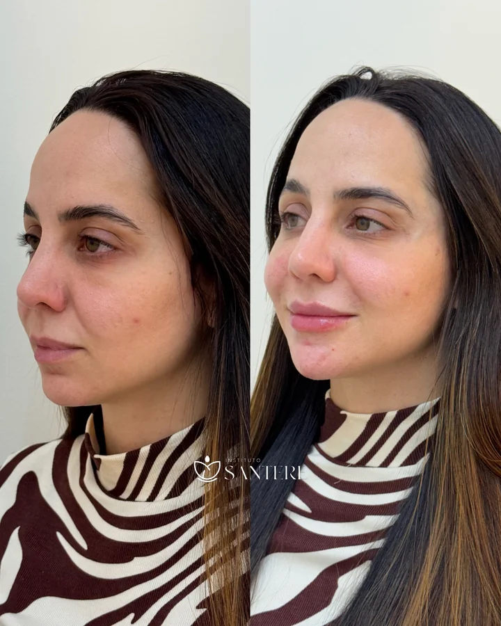 Antes e depois de harmonização facial, frontal