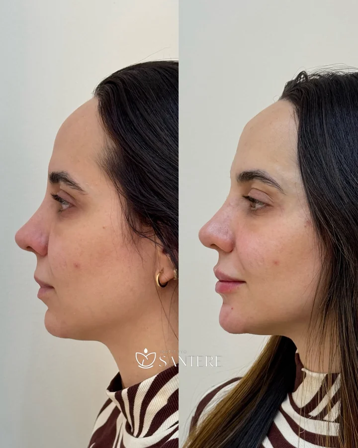 Antes e depois de harmonização facial, perfil